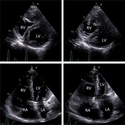 Case report: Myocardial perfusion gated-SPECT in pulmonary artery hypertension—the Movahed's sign